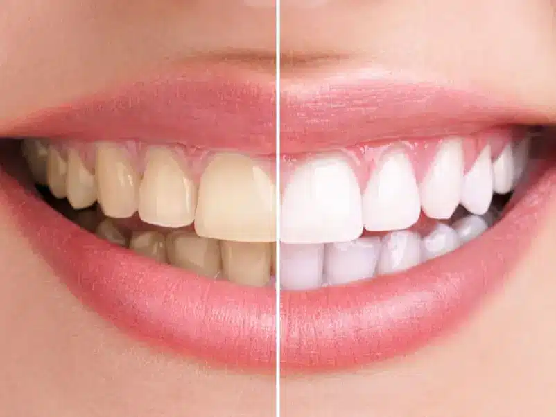 blanchiment-des-dents-802x602