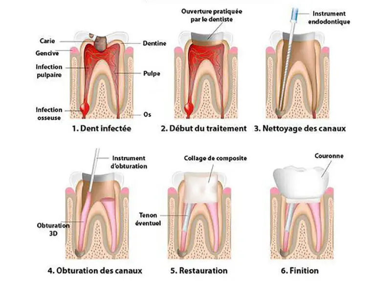 cdl-nos-services-endodontie-traitement-802x602