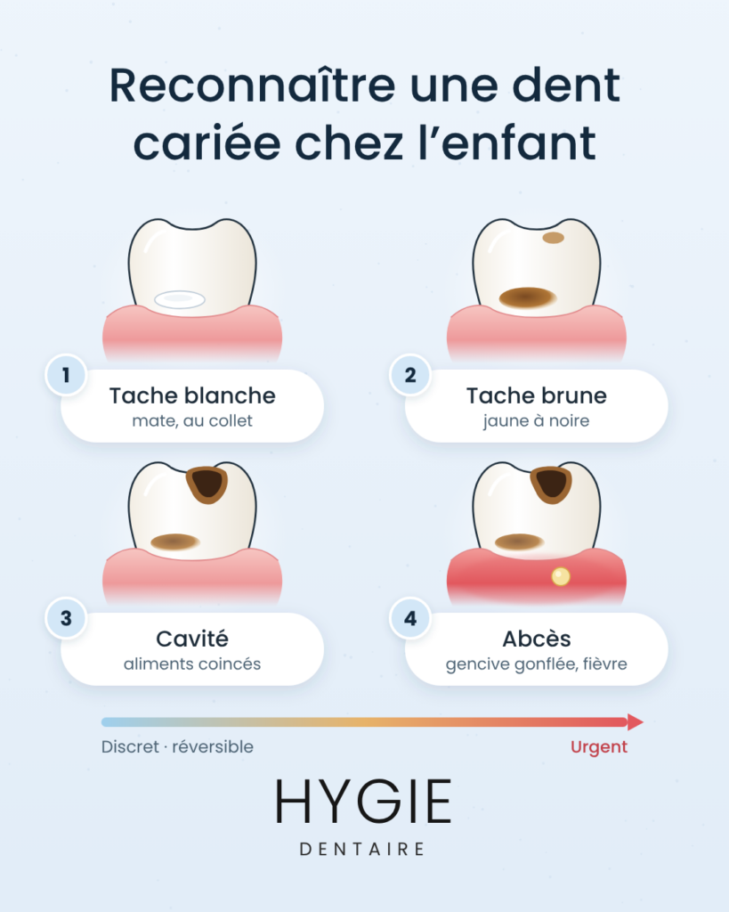 Dents de lait d’un enfant présentant différents signes de carie : taches blanches, cavité dans la dent et abcès dentaire.
