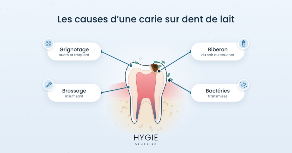 Carie dent de lait : les causes et solutions