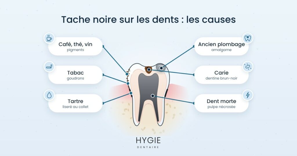 Tache noire sur une dent : les causes et solutions